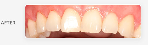 crown-lengthening-after-banner