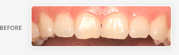 crown-lengthening-before-banner