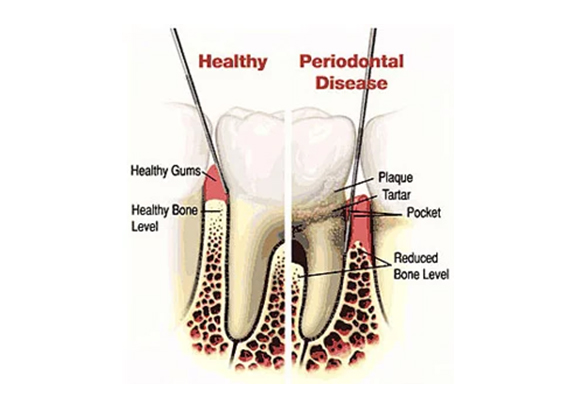 Periodontal Disease Treatment 2