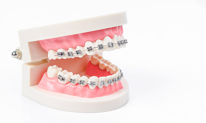 Braces and Gum Inflammation
