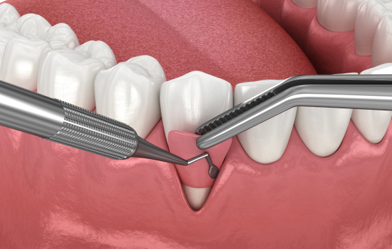 what is gum grafting what is gum grafting