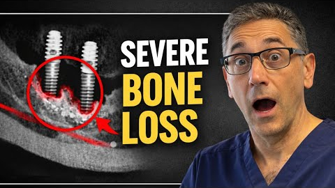 Severe Bone Loss and Dental Implants: Treatment Options in Poway, CA
