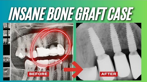 Replacing a Failing Dental Bridge with Implants in Poway, CA