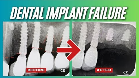 Failed Dental Implants in Poway, CA: Sinus Lift and Bone Grafting Solutions